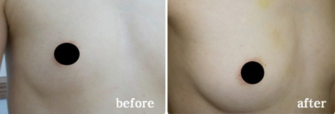 Needle Embedding Breast Augmentation Korea Medical Hub KMH